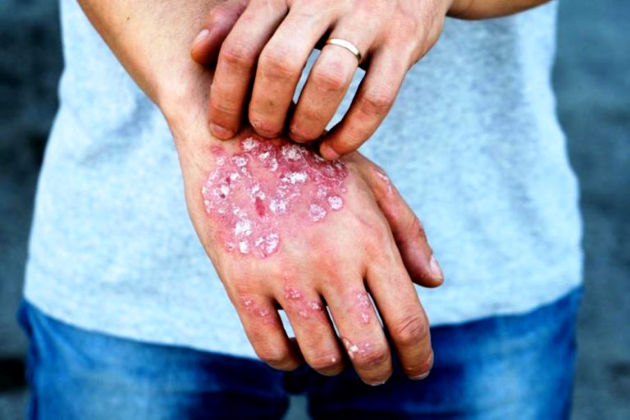 Évaluation des meilleurs remèdes contre le psoriasis pour 2020